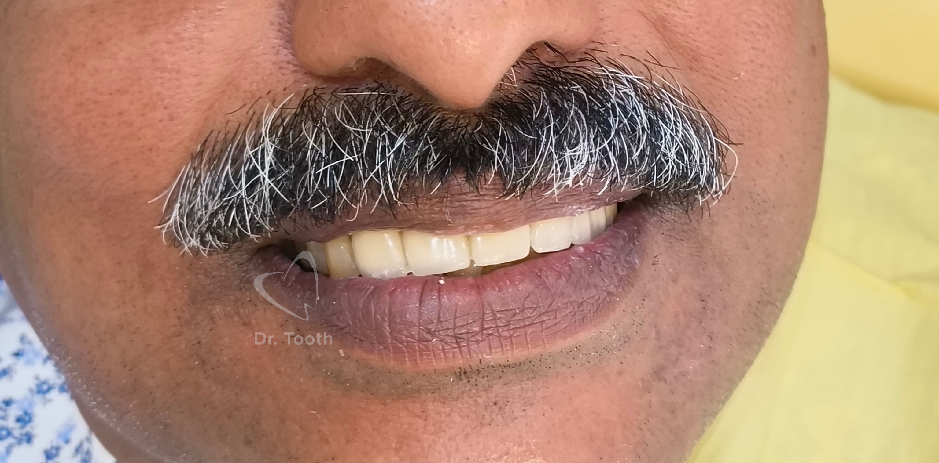After treatment