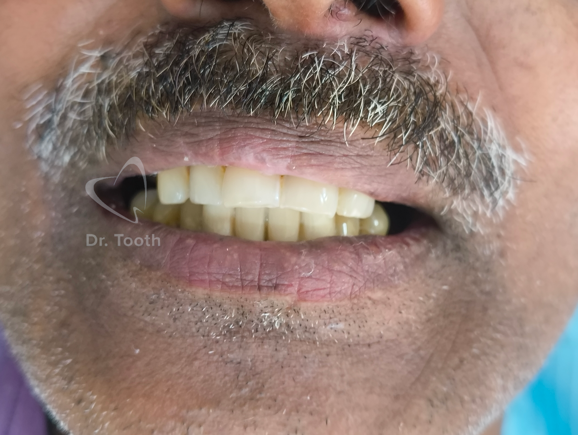 After treatment