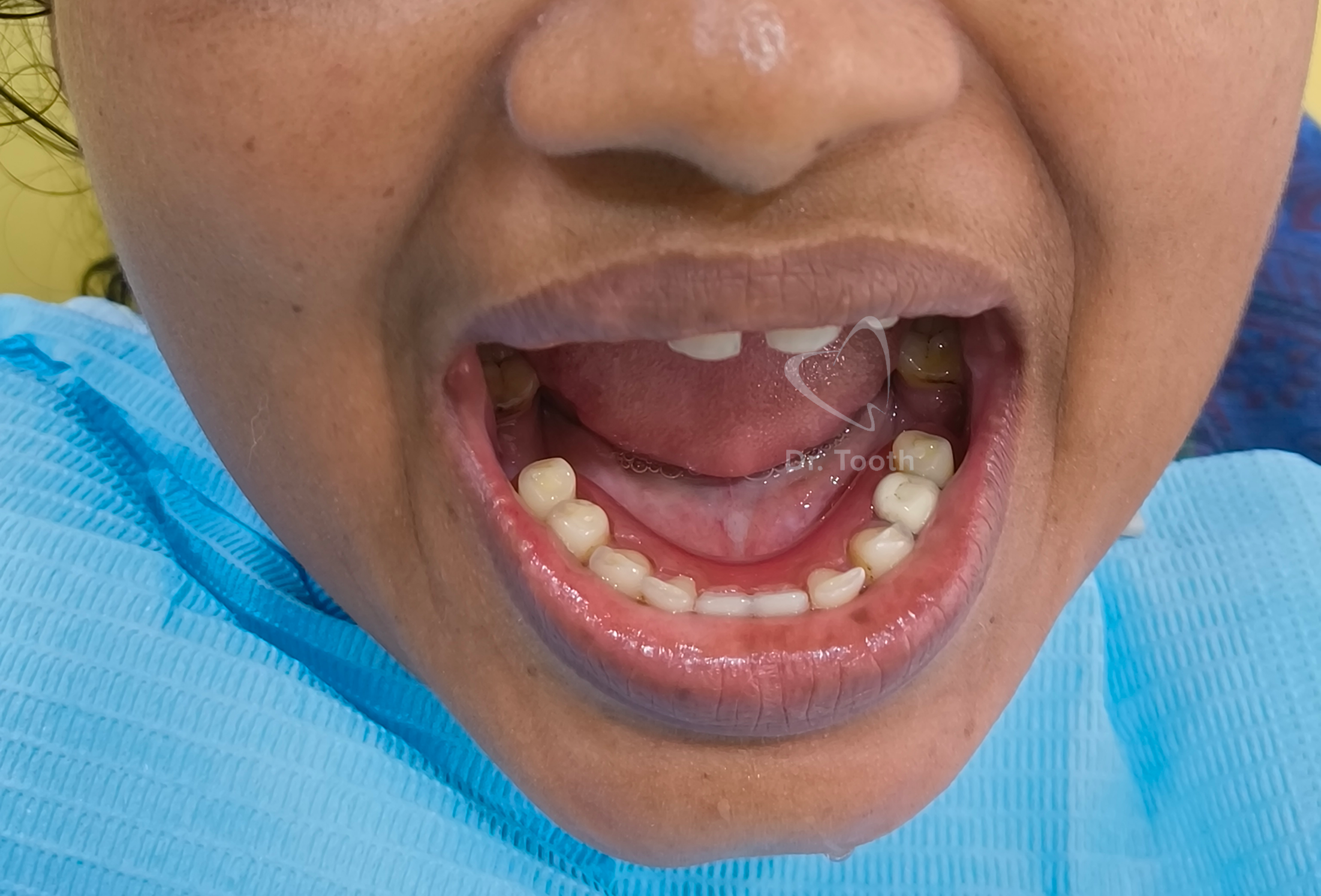 After treatment
