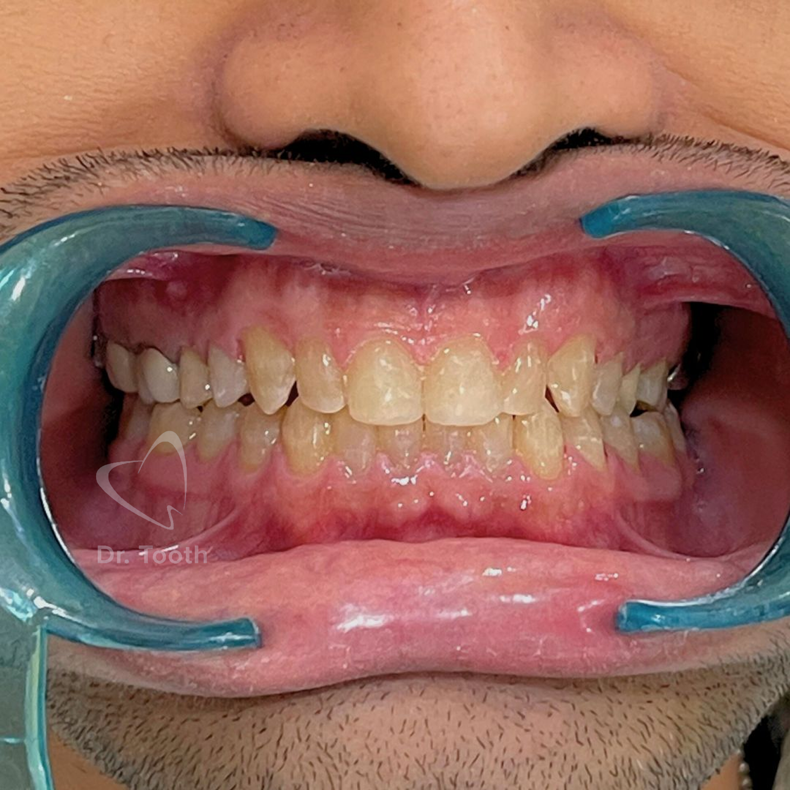 After treatment