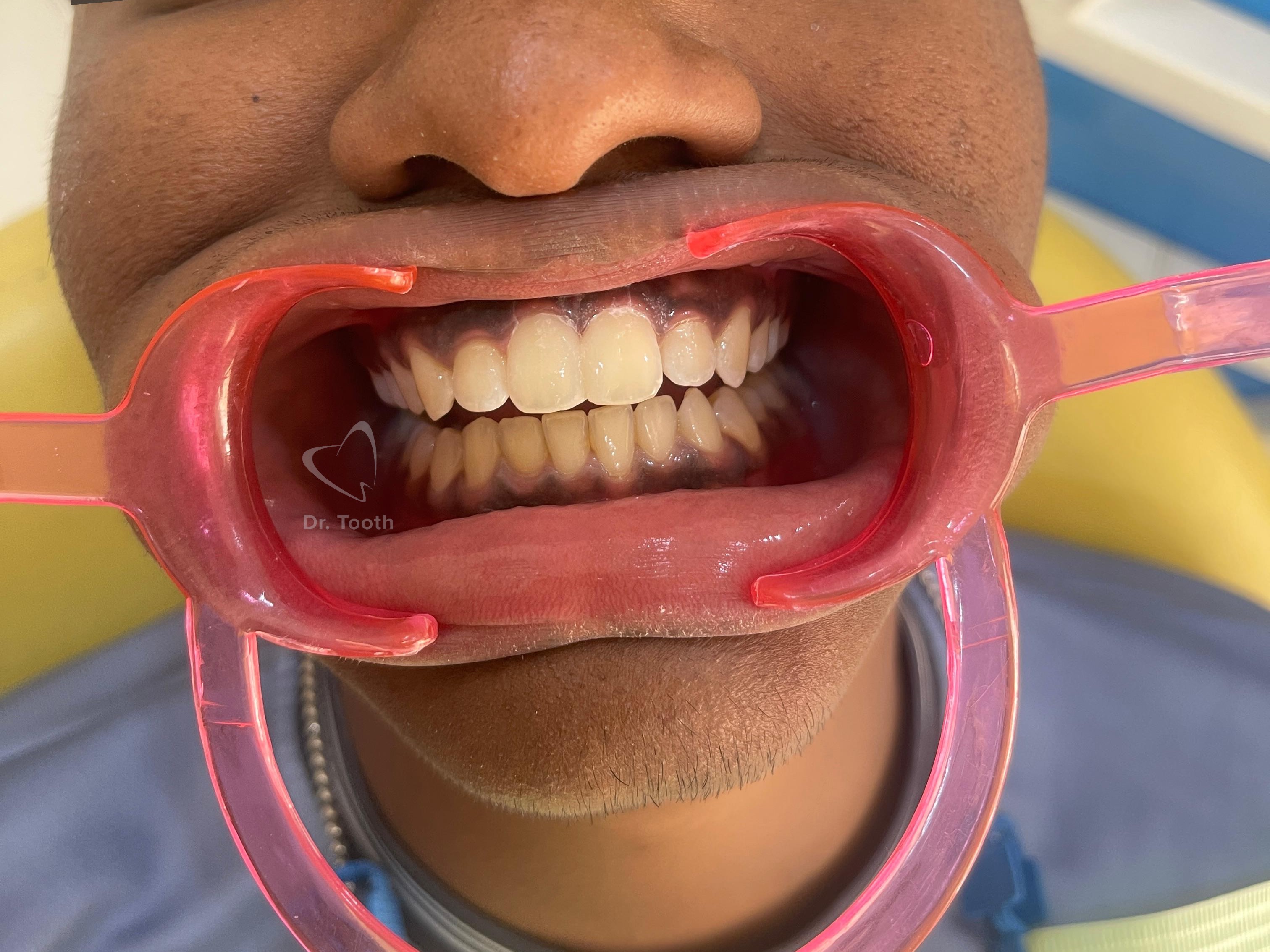 After treatment