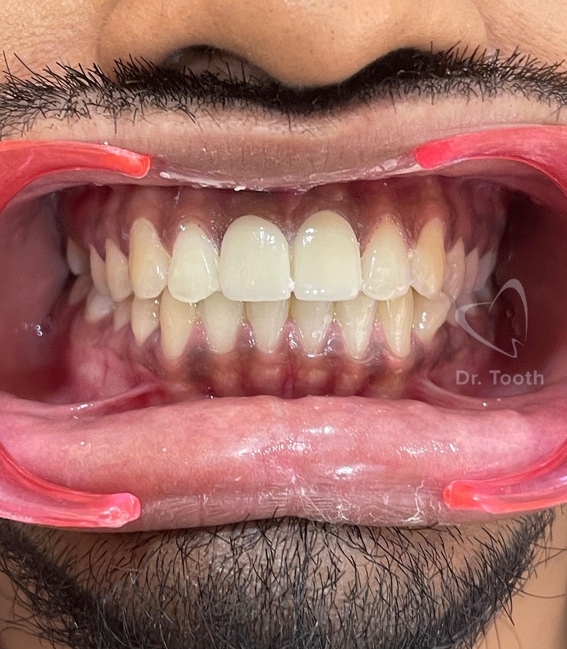 After treatment