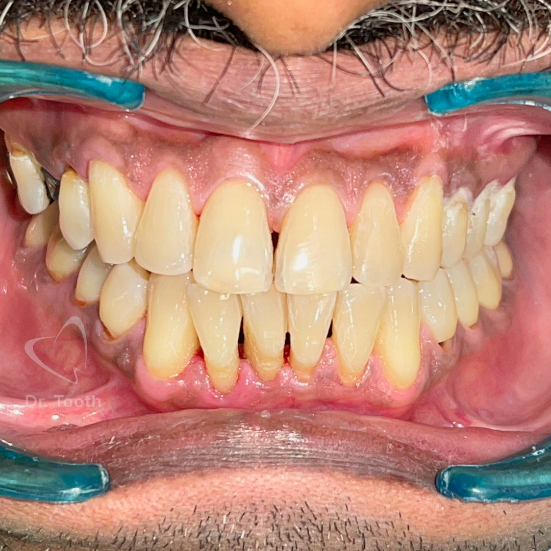 After treatment