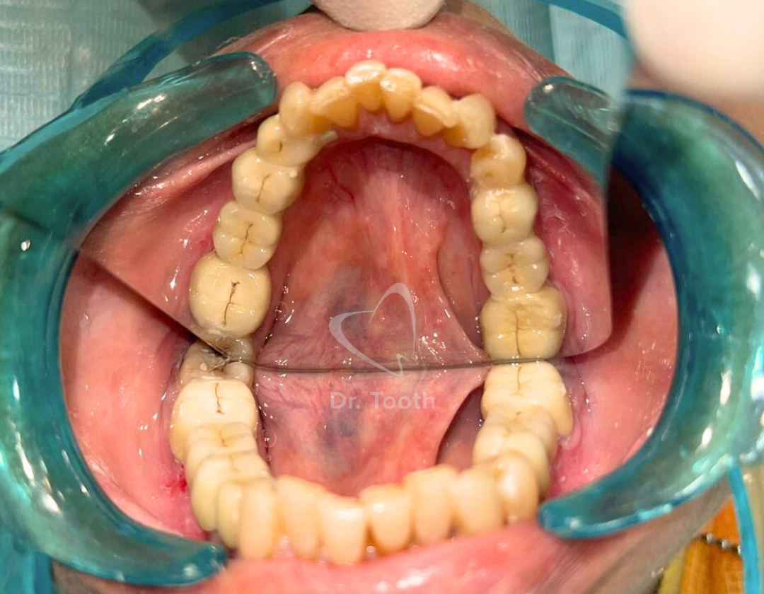After treatment