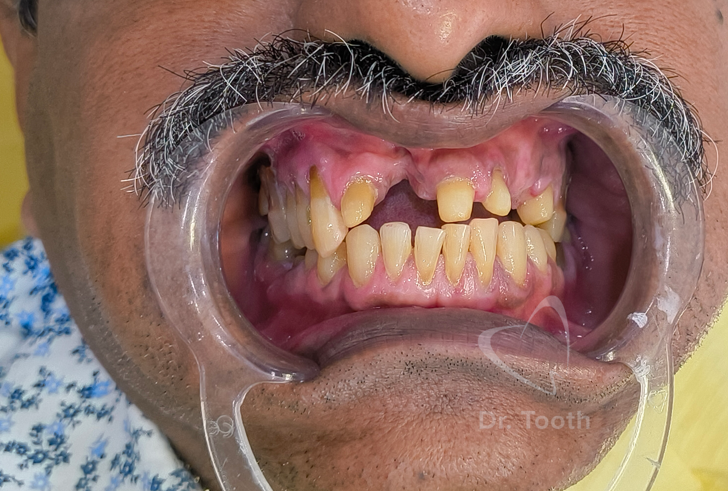 Before treatment