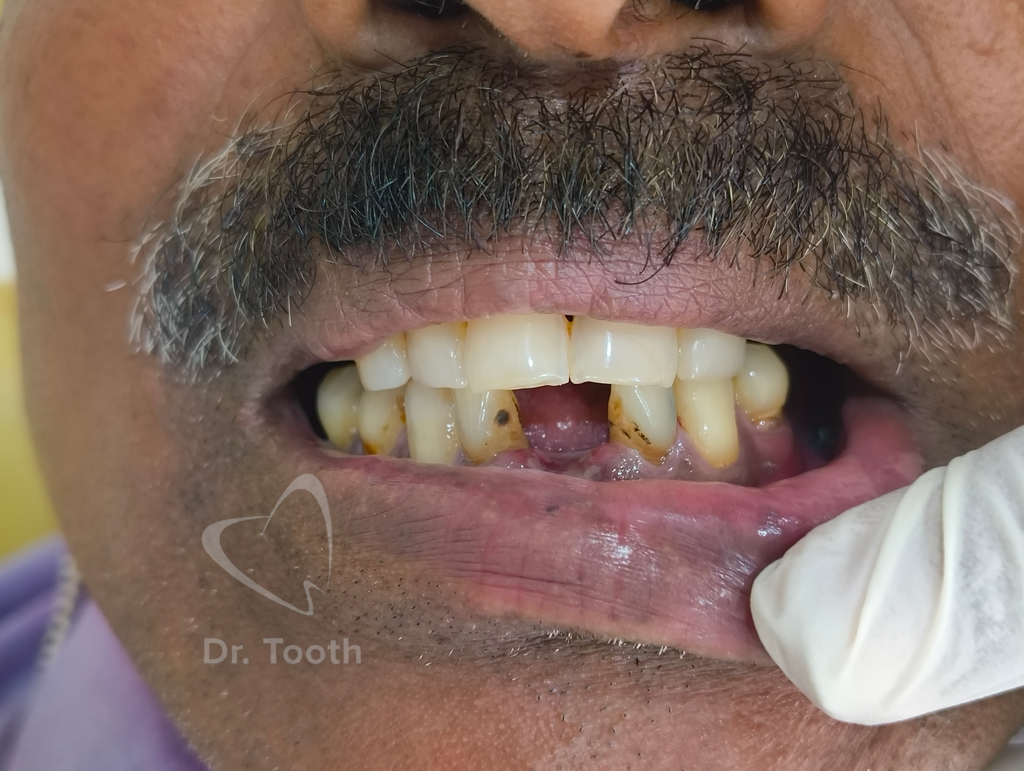 Before treatment