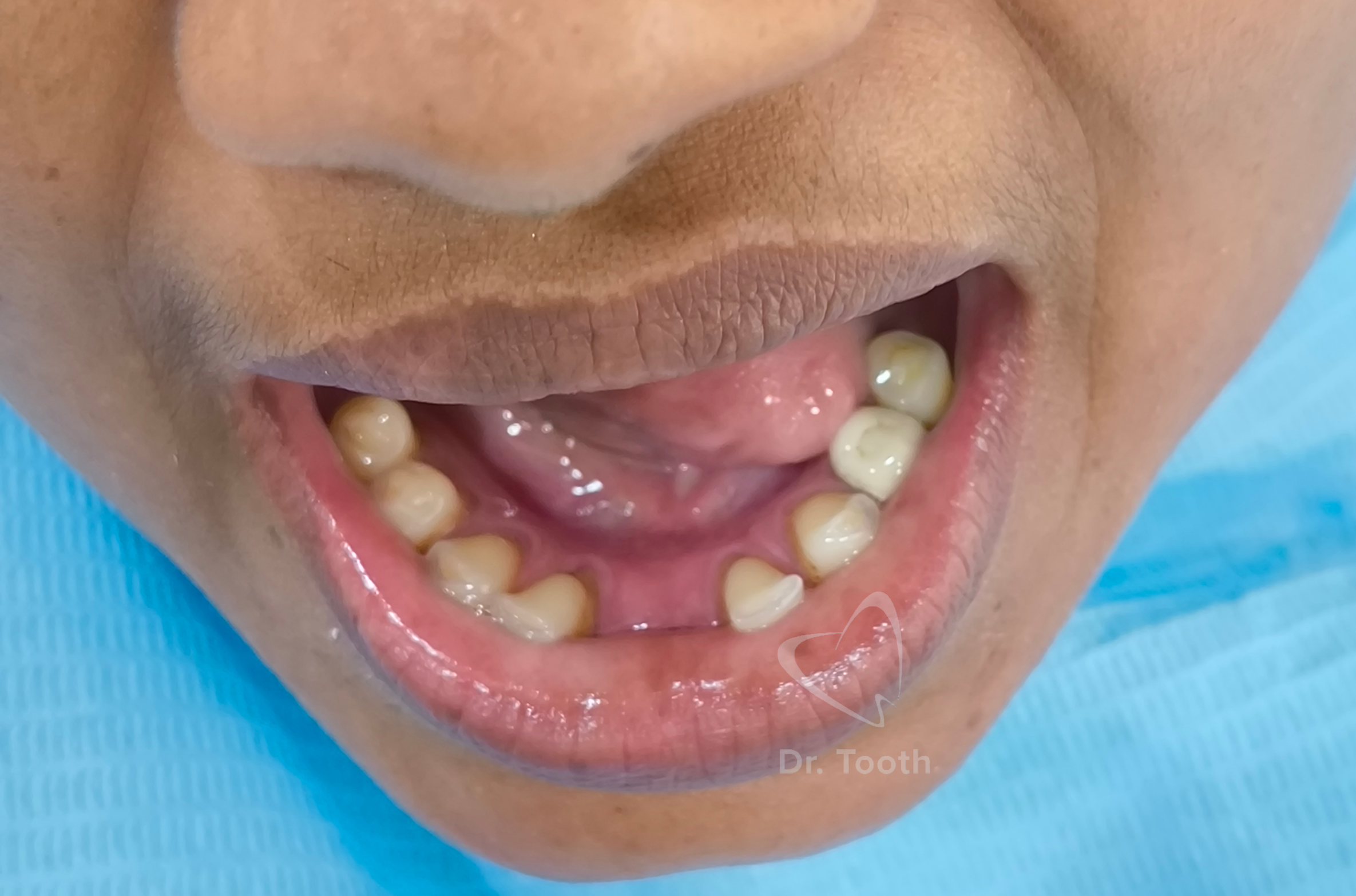 Before treatment