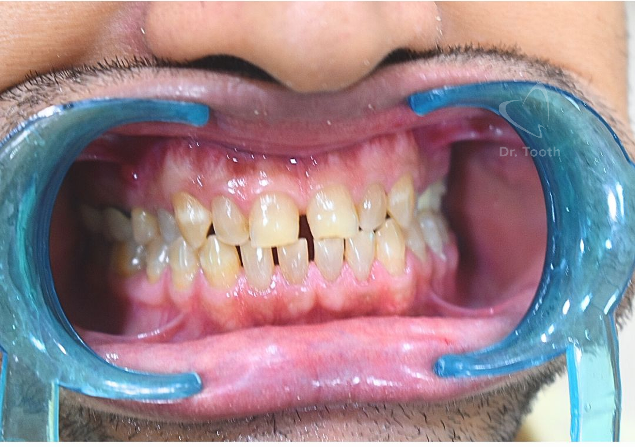 Before treatment