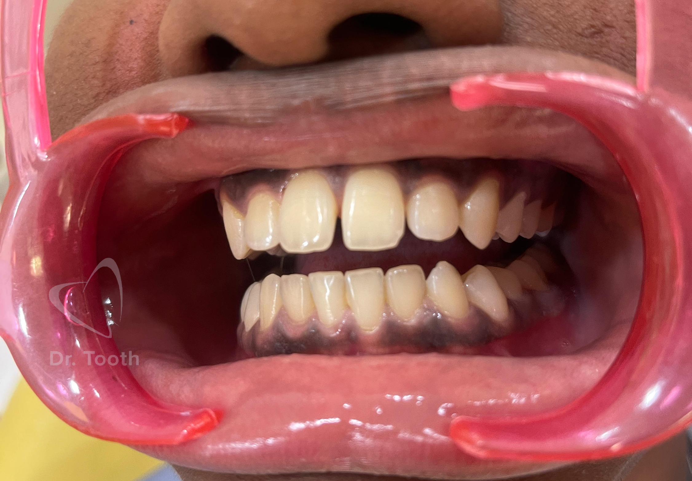 Before treatment