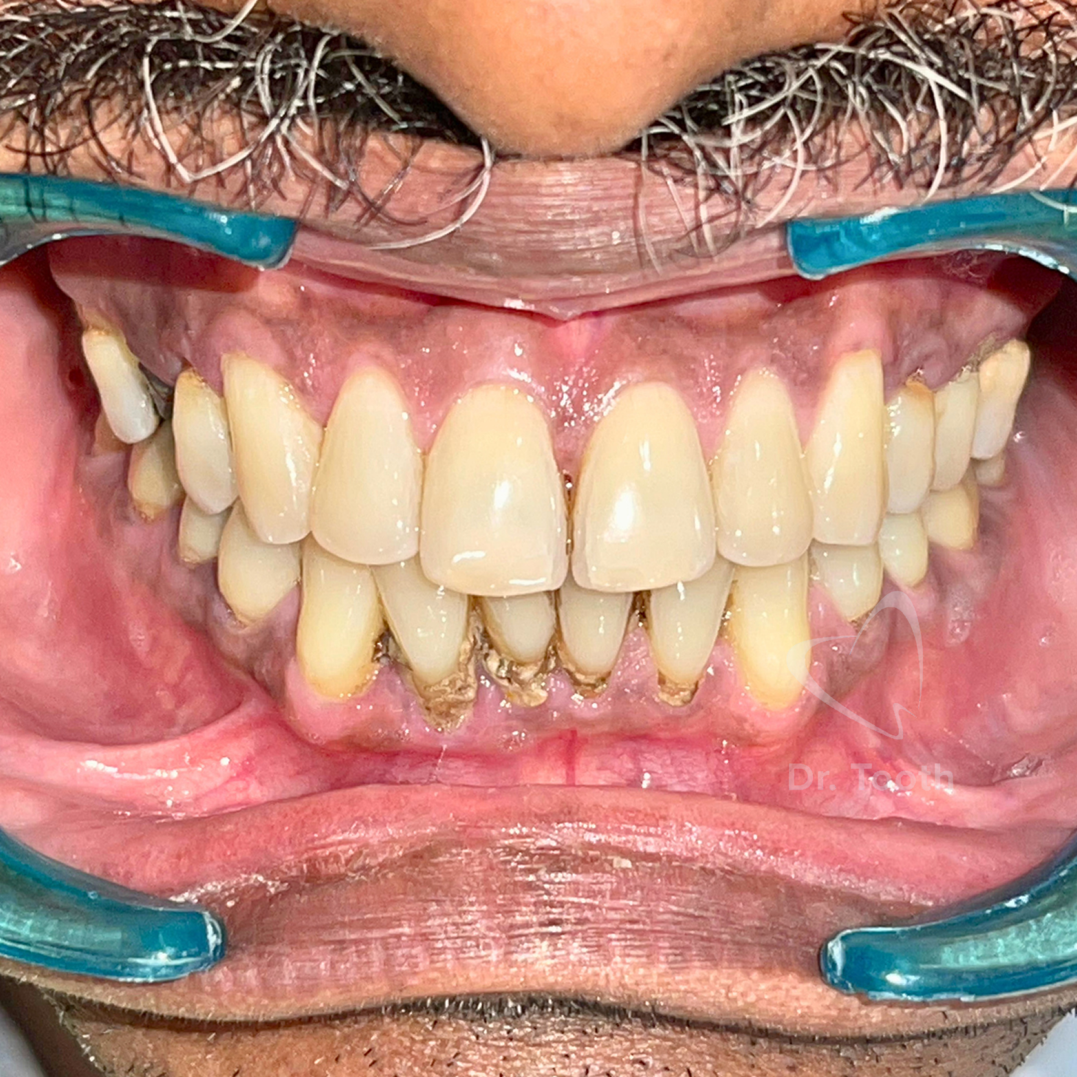 Before treatment