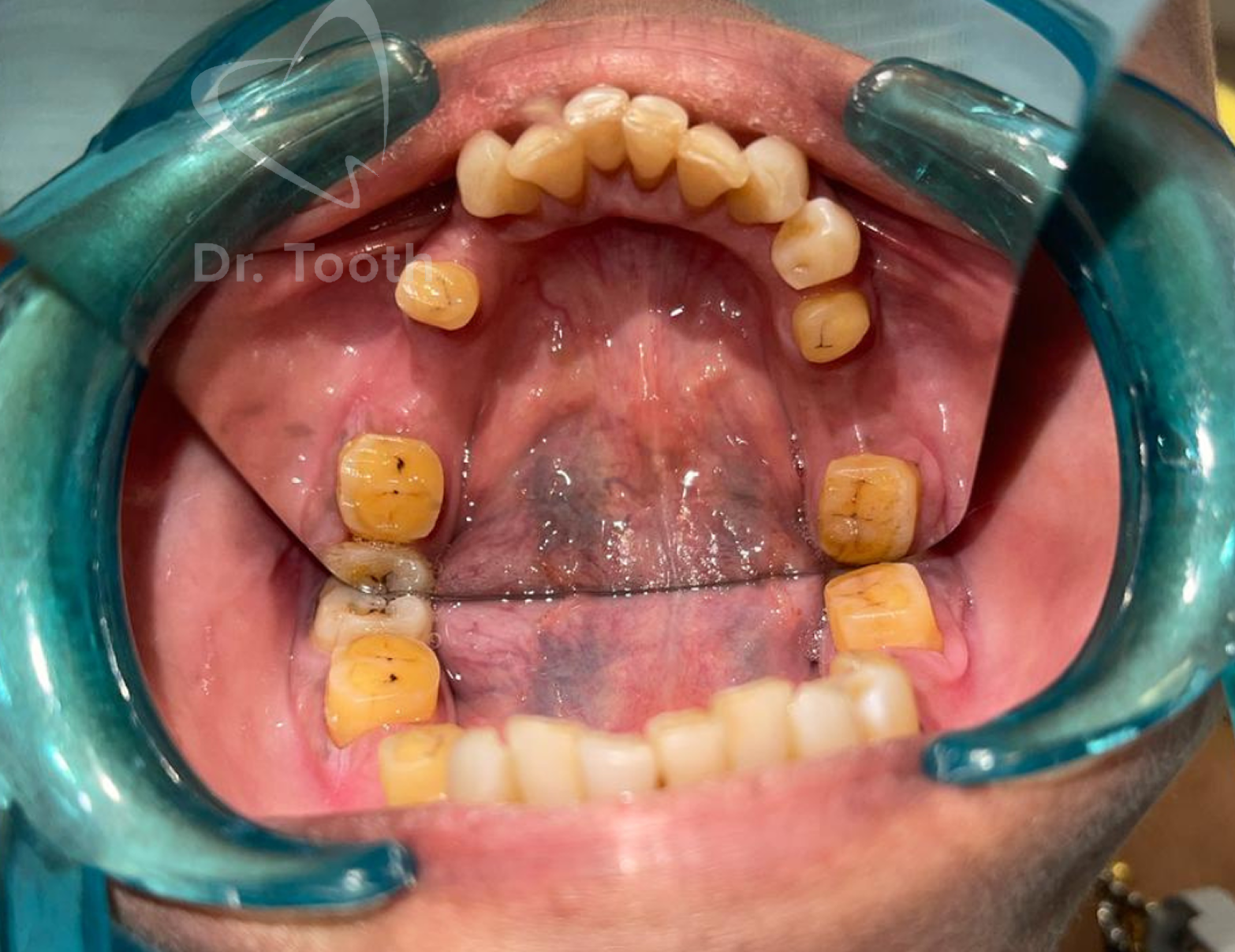 Before treatment
