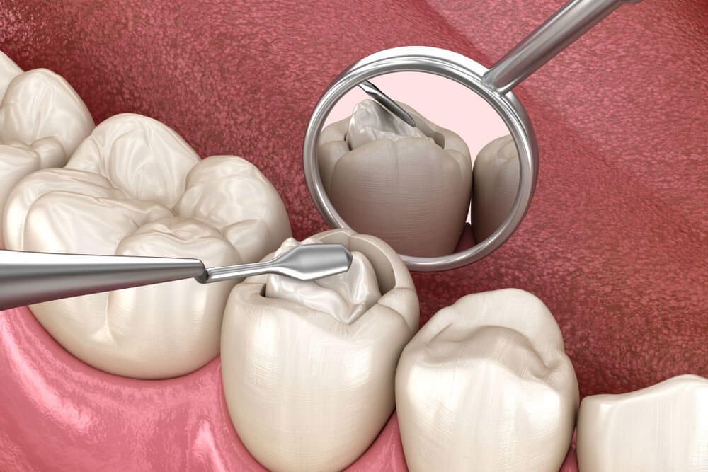 Composite Restoration 