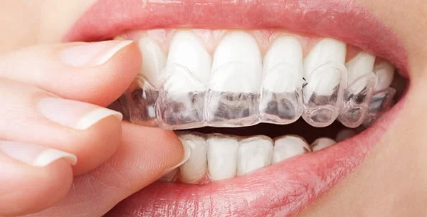 Clear Retainers 