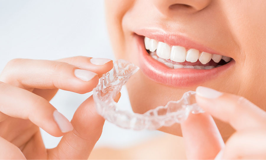 Clear Aligners