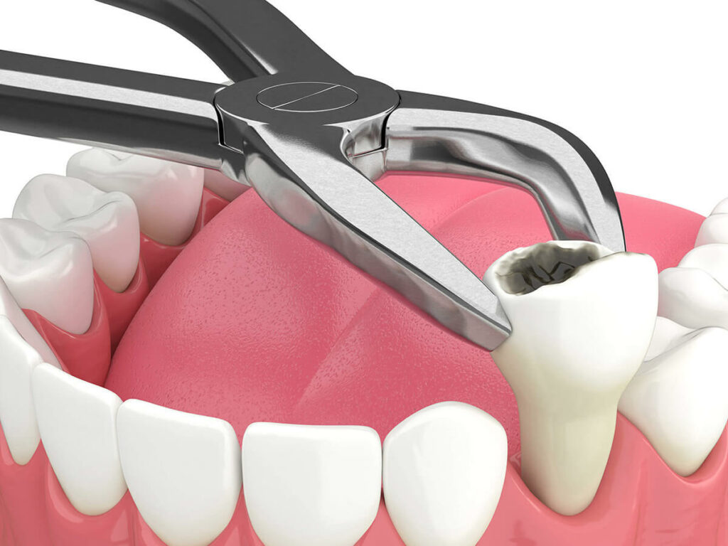 Surgical extraction