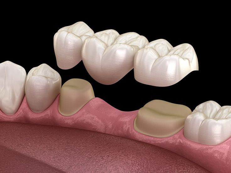 Fixed Prosthesis 