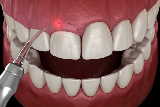 Gingivectomy