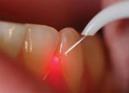 Laser Dentistry