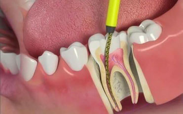 Root canal treatment 