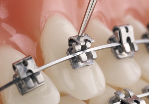 Self ligating Orthodontics