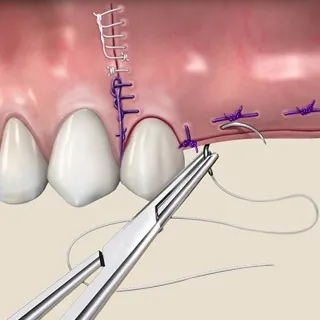 Suture removal