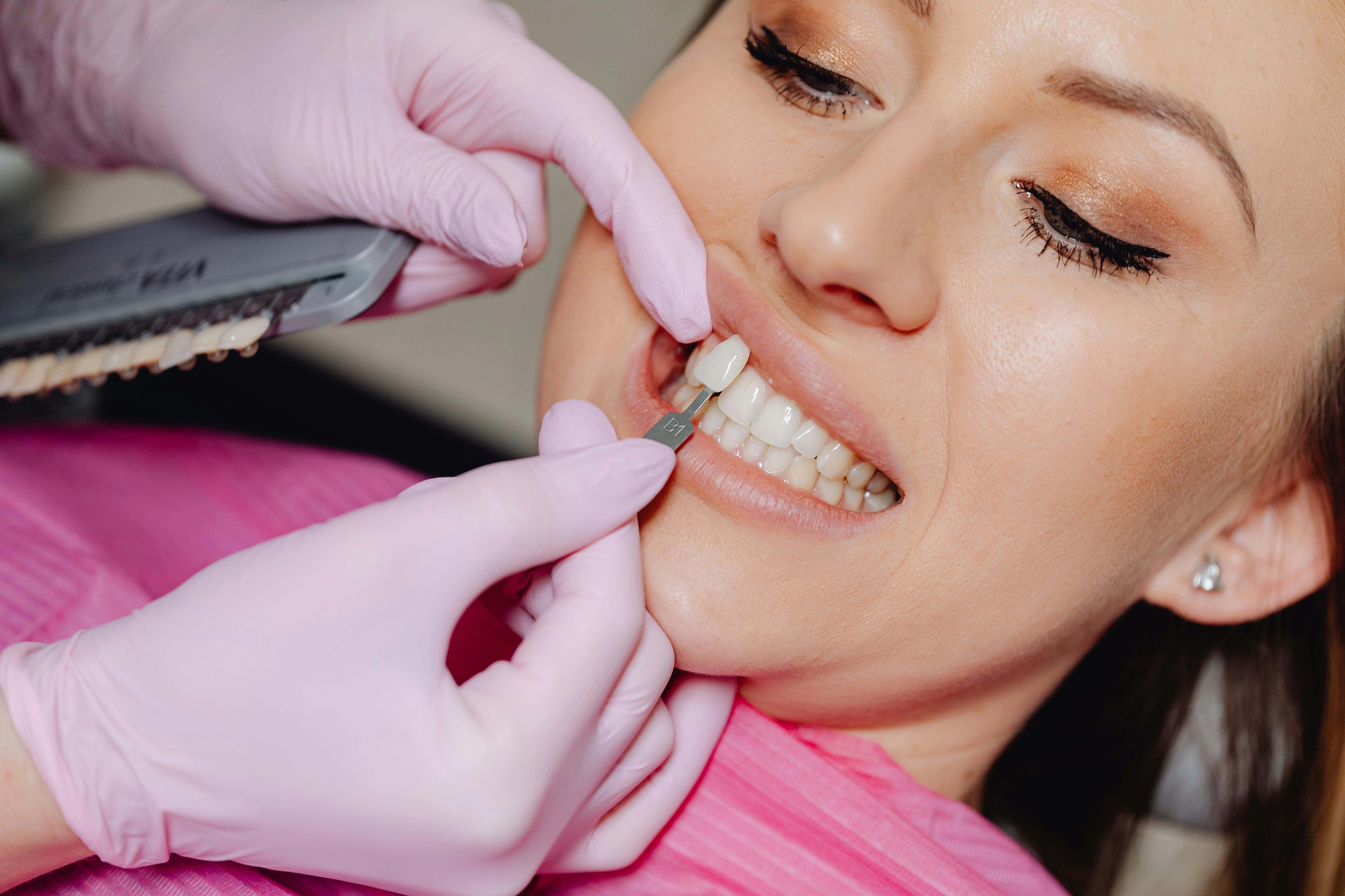 Dental Veneer