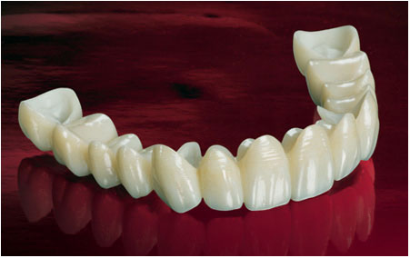 Zirconia crowns & Bridges