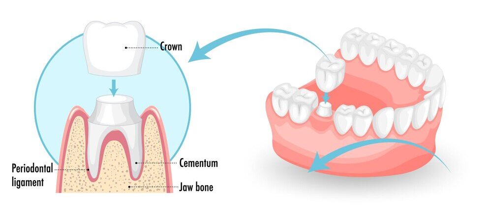 Dental Crown